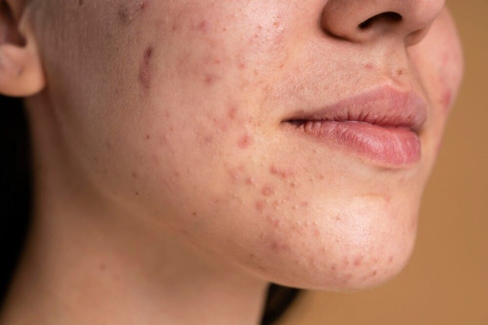 Todo lo que debes saber sobre el acné